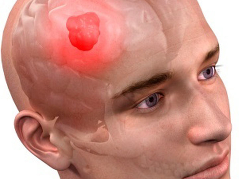 025-How-to-Know-if-a-Headache-is-a-Symptom-of-a-Brain-Tumor.jpg