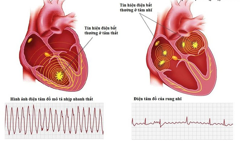 điều trị rối loạn nhịp tim