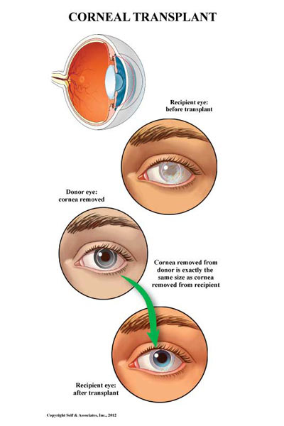 cornea transplant in india