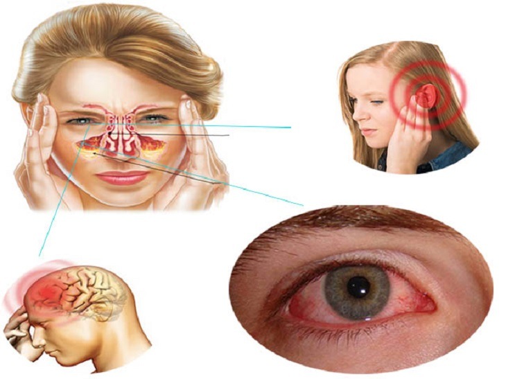 Viêm xoang sàng nếu không chăm sóc, điều trị đúng cách sẽ cực kỳ nguy hiểm Viêm xoang sàng nếu không chăm sóc, điều trị đúng cách sẽ cực kỳ nguy hiểm