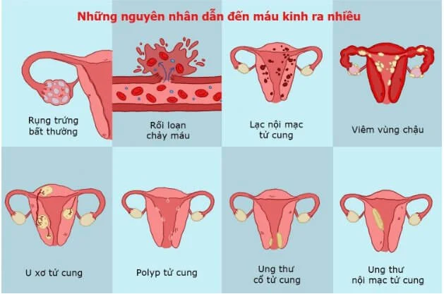 Một số nguyên nhân dẫn đến tình trạng máu kinh ra nhiều