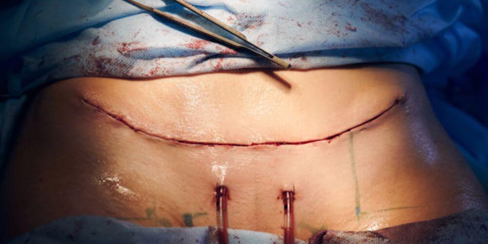 une femme allongée sur une table de chirurgie avec une incision sur son ventre