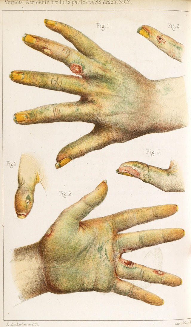 A sketch showing hands covered with ulcers