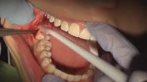 Image result for wisdom teeth