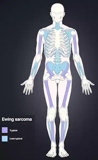 What is Ewing sarcoma