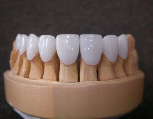các loại răng toàn sứ