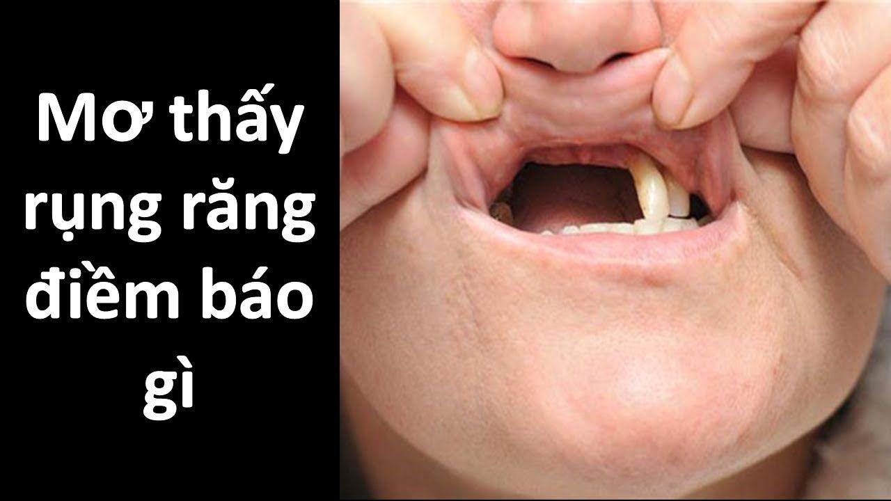 Giải mã nằm mơ thấy rụng răng không chảy máu báo điềm gì? -  lichvietnam.com.vn