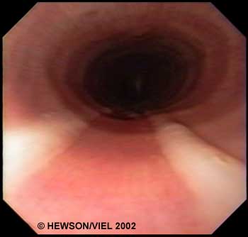  Endoscopic view of streams of mucopus in the trachea. 