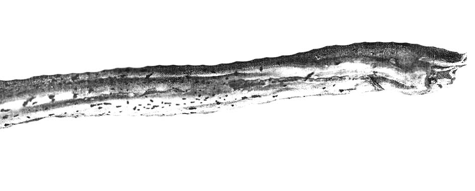 Umbilical cord showing the foci of pigmented squamous metaplasia
