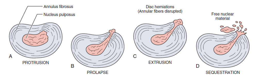 Intervertebral disc prolapse diagram that affects range of motion of the spine 