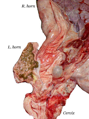 Second pregnancy with opened left uterine horn