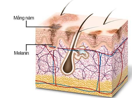 Sắc tố Melanin – nguyên nhân hình thành sạm, nám, tàn nhang, vết thâm
