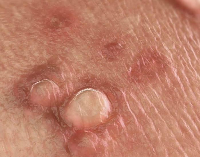 Herpes Simplex Virus gây mụn nước ở vùng kín