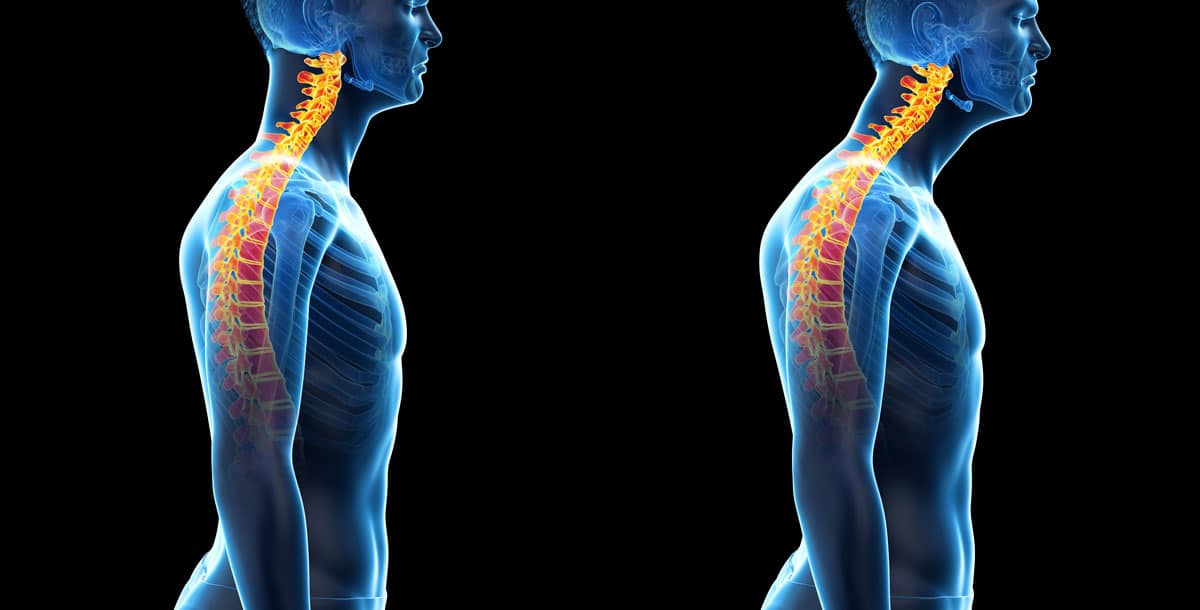 A good posture versus a poor posture