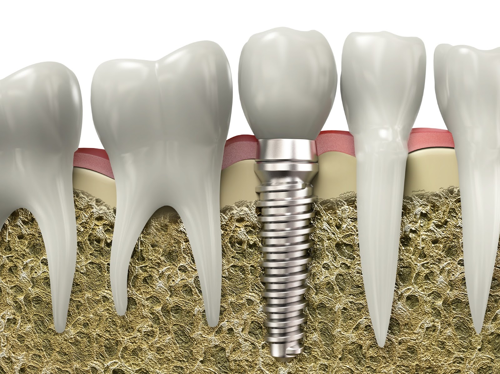 giá răng implant;bảng giá cấy ghép implant;làm răng implant;cấy ghép implant răng;giá tiền trồng răng implant;bảng giá làm răng implant;trồng implant