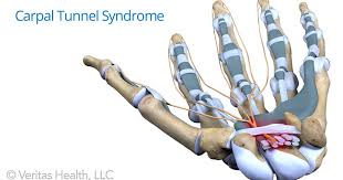 Image result for carpal tunnel syndrome