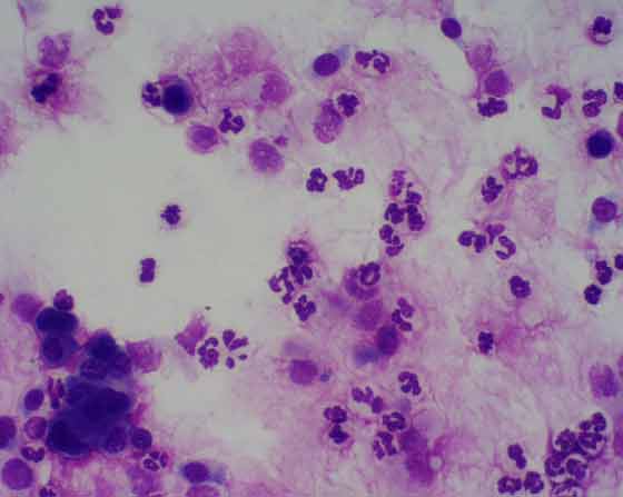 Many neutrophils and excess mucus in a TA of a horse with IAD.