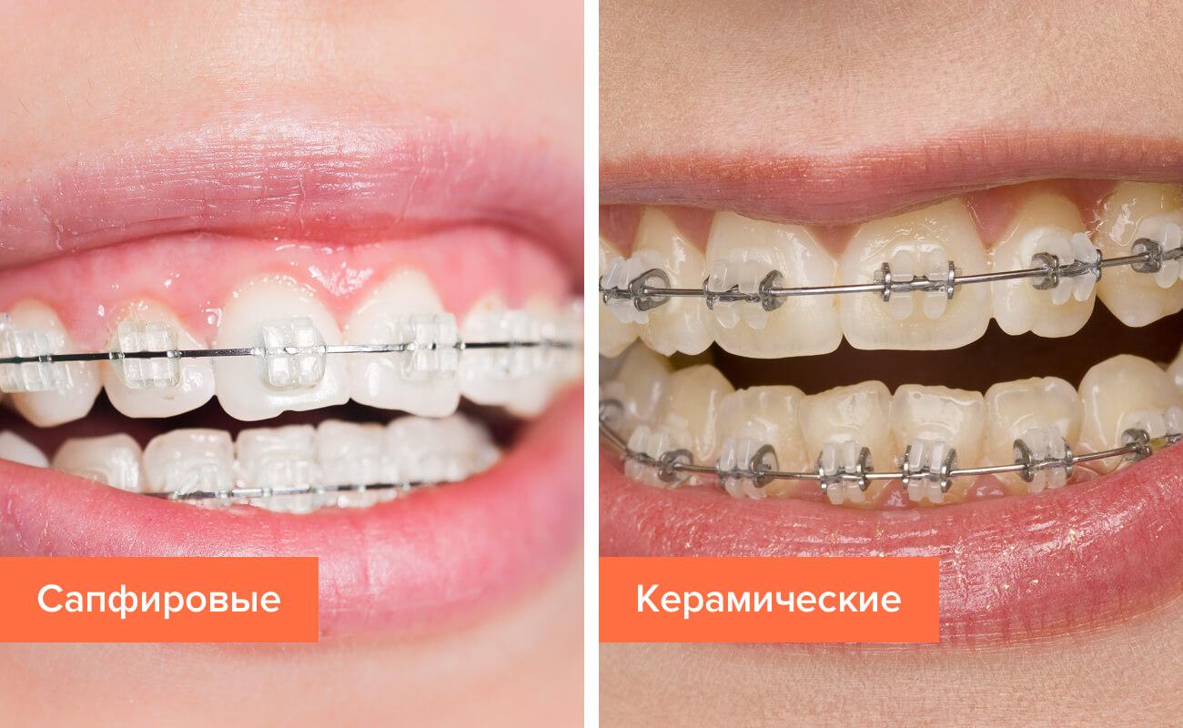 Сапфировые брекеты — установка, отзывы, фото до и после лечения ...