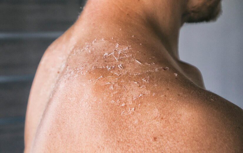 “Itchy Skin”ผิวคันง่ายหรือเปล่า?อาจไม่ใช่แค่ผิวแห้งที่ทำให้คันผิวมีอีกหลายสาเหตุมาดูกัน!3