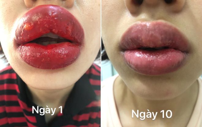 Với công nghệ phun môi hiện đại, diễn ra an toàn, ít xâm lấn thì hầu hết đối với những khách hàng có cơ địa bình thường