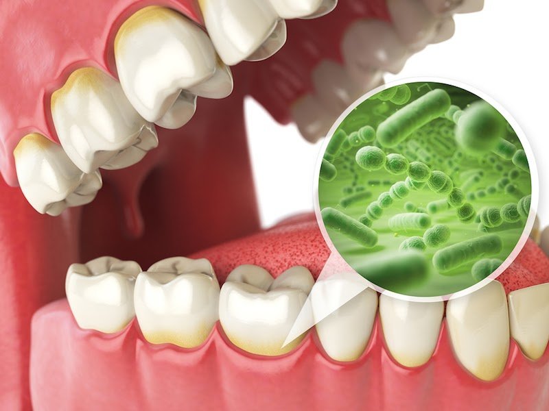 Vi khuẩn Streptococcus mutans là tác nhân gây sâu răng