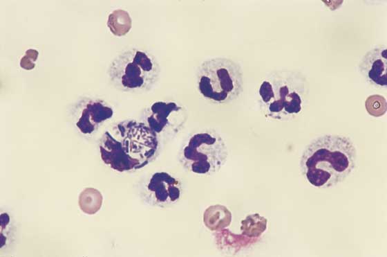 Abdominal fluid. Mixture of degenerate and nondegenerate neutrophils with phagocytosed rod-shaped bacteria indicates septic peritonitis (100x).