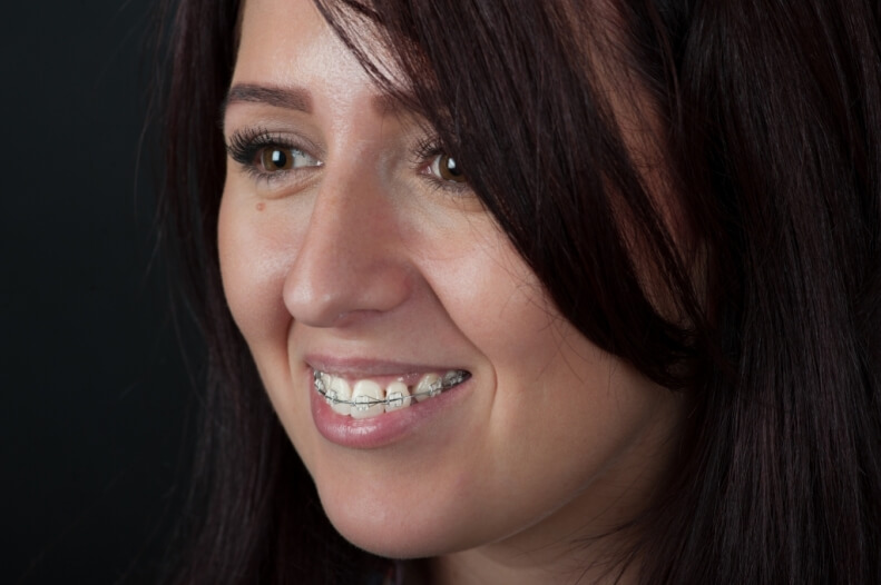 Aparat dentar safir | Clinica dentara Neoclinique