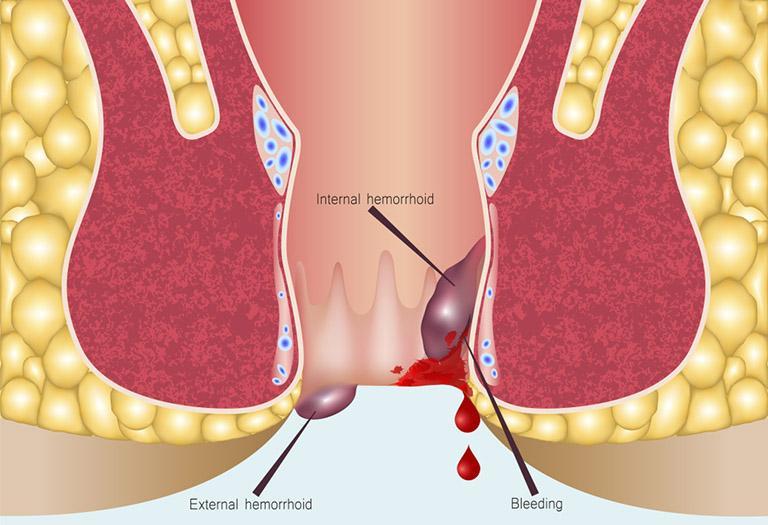 phương pháp điều trị bệnh trĩ mới nhất