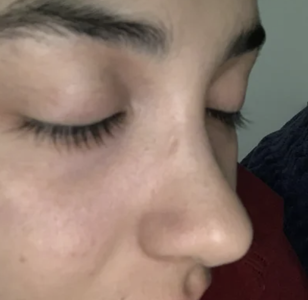 Dallas Rhinoplasty Center review