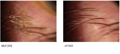 Image result for blephex before and after