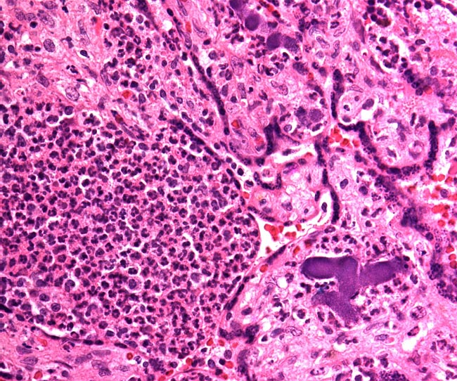 Abscess in villi with dark purple colony of bacteria at right