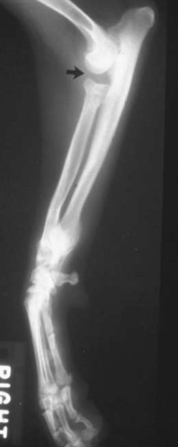 Radiograph showing premature closure of the proximal radial physis resulting in substantial widening of the radiohumeral joint, radioulnar malarticulation and shortening of the antebrachium