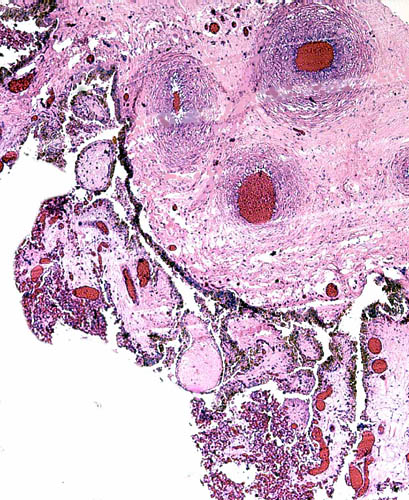 Another section of the placental surface with pigmented trophoblast