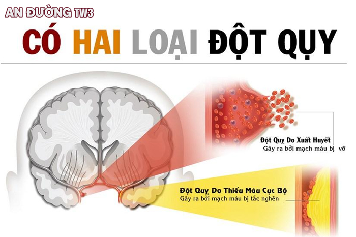 Bệnh đột quỵ