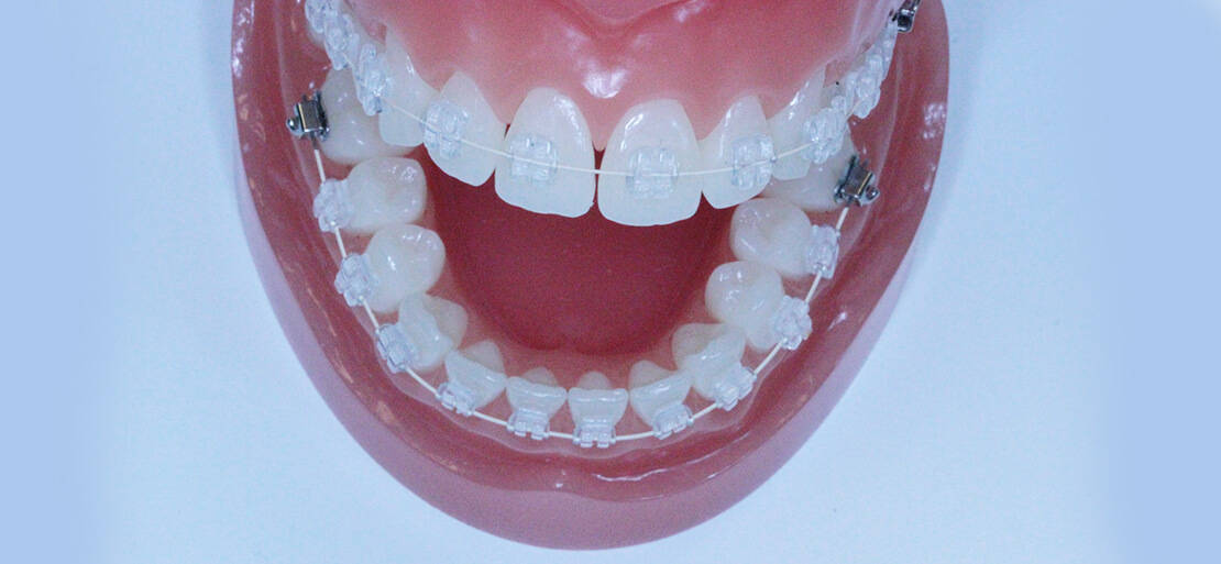 Aparat dentar ceramic - Clinica SyroDent