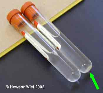  BAL fluid prior to centrifugation (left) and a pellet of cells (arrow) visible at the base of the tube in the centrifuged sample (right).