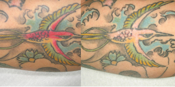 Guide On Q Switch Laser Tattoo Removal | Tattoo Removal Institute