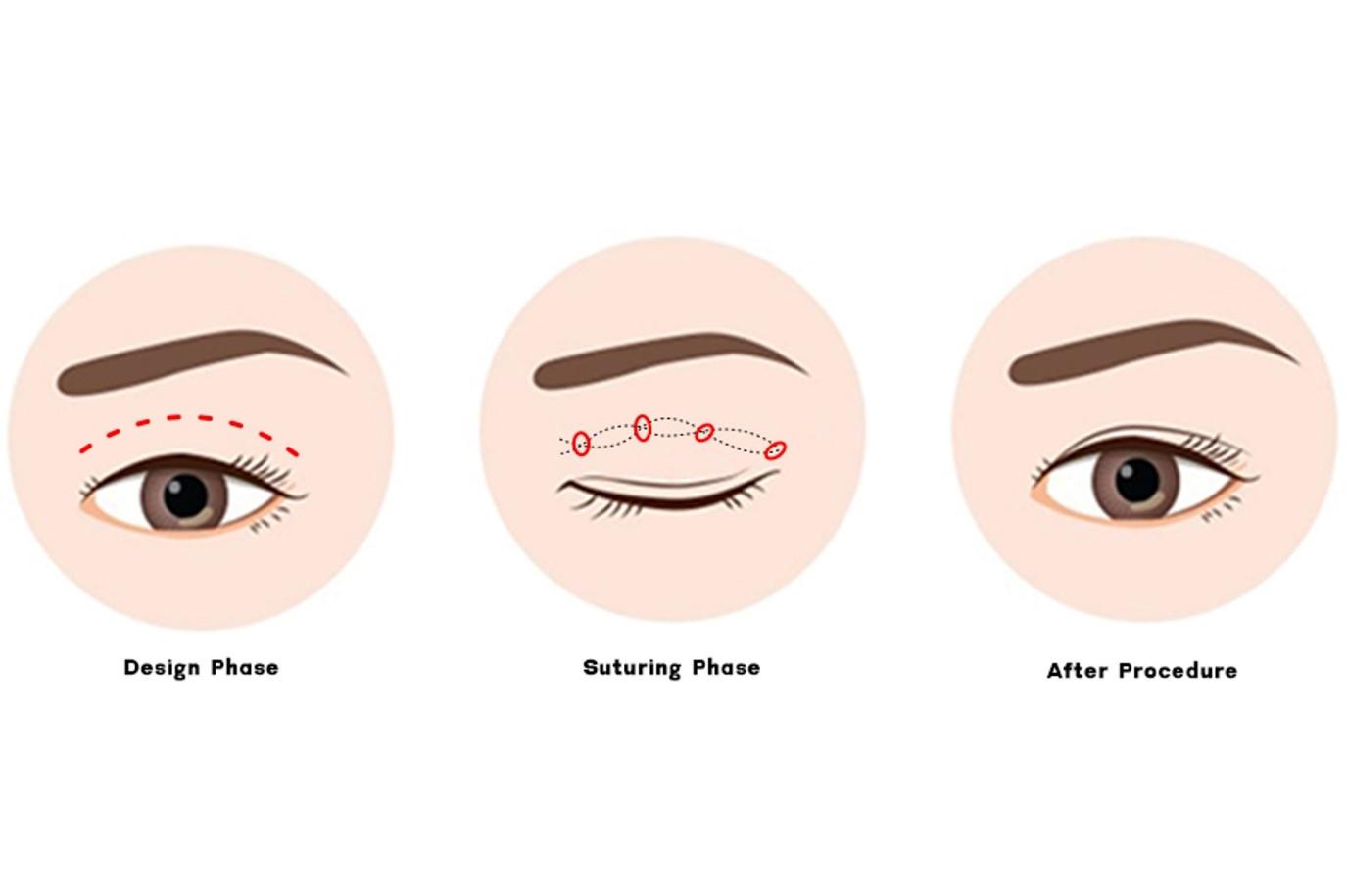 double eyelid stitching procedure details