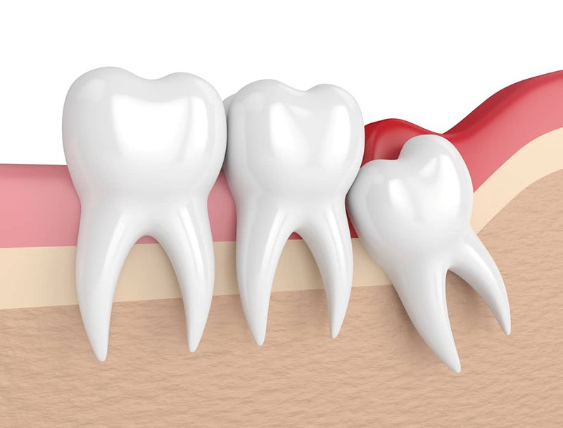 Răng khôn mọc ở vị trí trong cùng của hàm răng