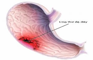 Công dụng phòng ung thư dạ dày và ung thư da của tỏi ngâm rượu