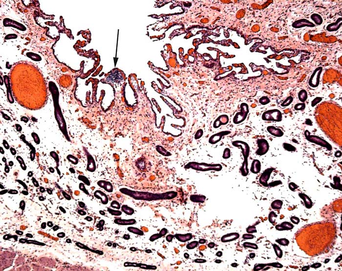 Higher magnification of the endometrium with arrow pointing at one of many collections of lymphocytes