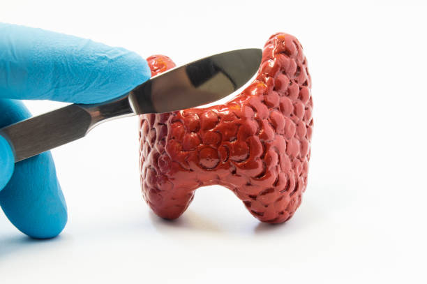 cirurgia de tireoide