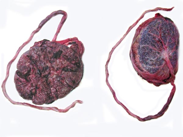 Typical term gorilla placenta, maternal surface at left. Note the long umbilical cord with few twists