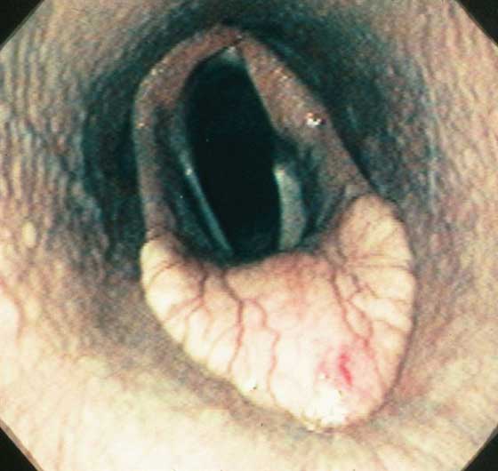 Left laryngeal hemiplegia with scarring of the left vocal cord.