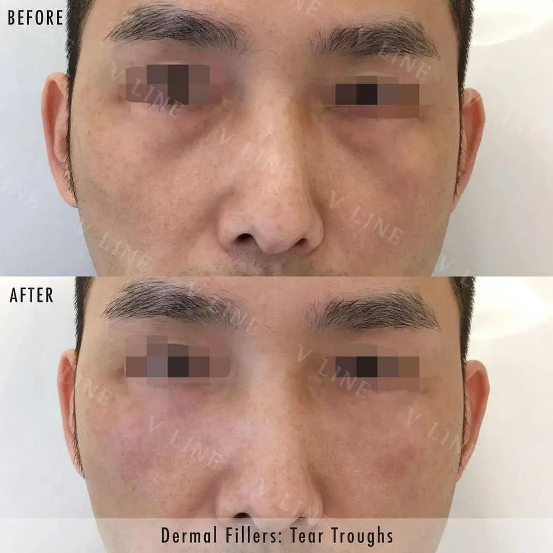 Before and After Transformation of Dermal Fillers Used to Remove Eye Bags