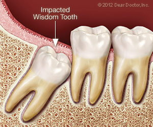 Impacted wisdom tooth.