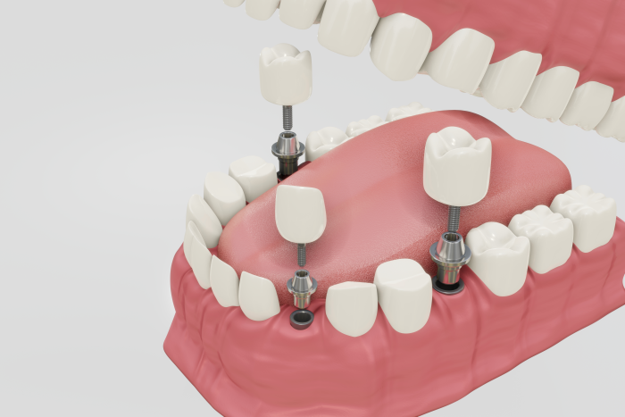 Aplicare implanturi dentare - Clinica SyroDent Bucuresti