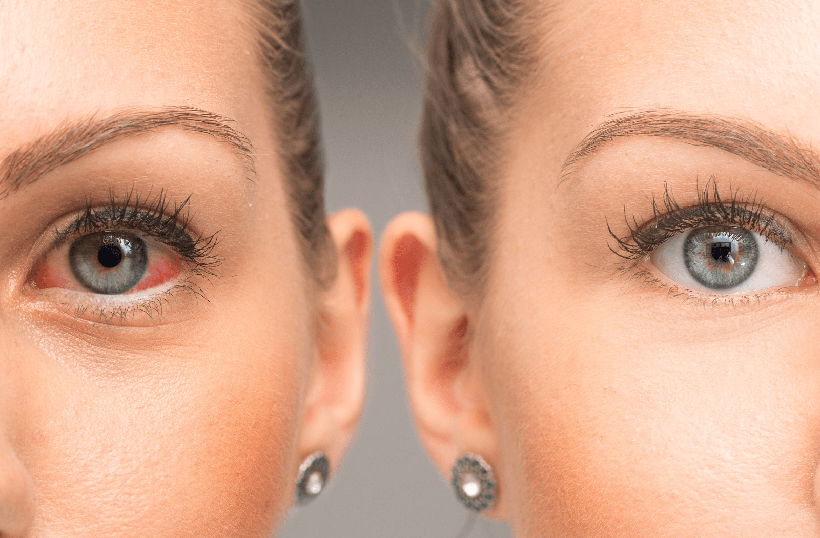 A comparison image of a woman's healthy eye with a woman's dry and red eye