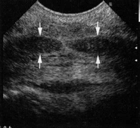 Normal transverse image of the DDFT at proximal P2 obtained by using the technique shown in Figure 11.
