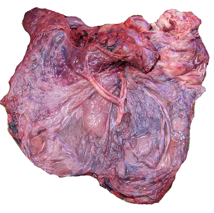 Placenta with central cord insertion whose four vessels